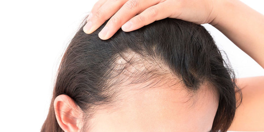 What is Alopecia? Is there a cure?